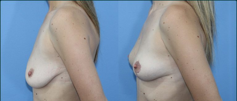 Breast lift (mastopexy) before and after, female patient, case BLI-L01, Dr Rohit Kumar, Sydney