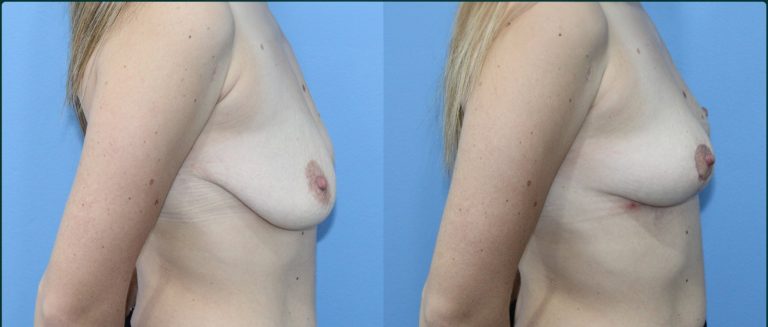 Breast lift (mastopexy) before and after, female patient, case BLI-L01, Dr Rohit Kumar, Sydney