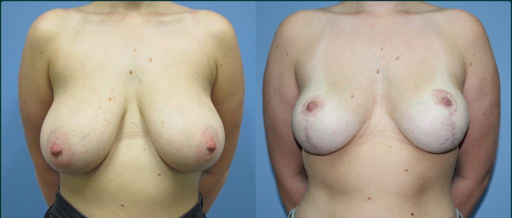 Breast lift (mastopexy) before and after, female patient, case BLI-L02, Dr Rohit Kumar, Sydney