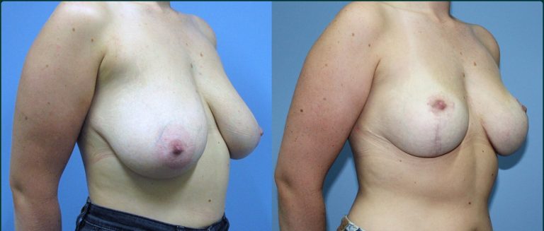 Breast lift (mastopexy) before and after, female patient, case BLI-L02, Dr Rohit Kumar, Sydney