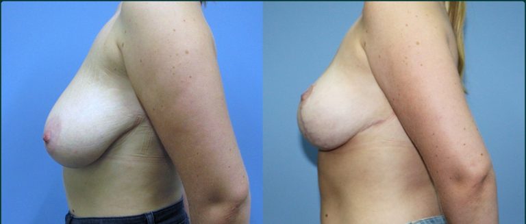 Breast lift (mastopexy) before and after, female patient, case BLI-L02, Dr Rohit Kumar, Sydney