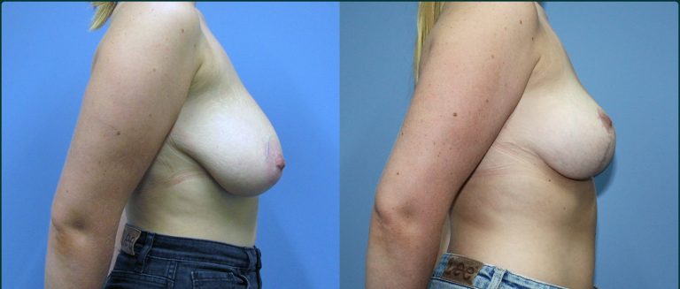 Breast lift (mastopexy) before and after, female patient, case BLI-L02, Dr Rohit Kumar, Sydney