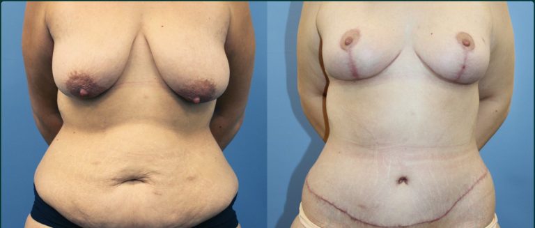Breast lift (mastopexy) before and after, female patient, case BLI-L03, Dr Rohit Kumar, Sydney