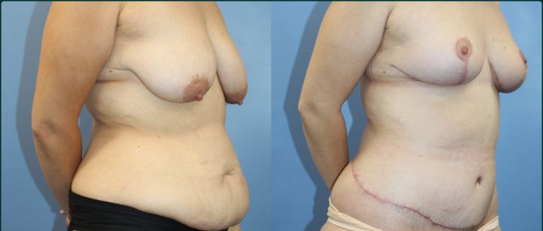 Breast lift (mastopexy) before and after, female patient, case BLI-L03, Dr Rohit Kumar, Sydney