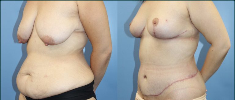 Breast lift (mastopexy) before and after, female patient, case BLI-L03, Dr Rohit Kumar, Sydney