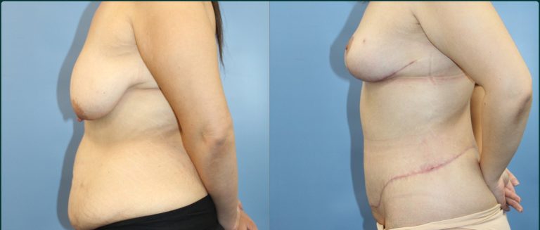 Breast lift (mastopexy) before and after, female patient, case BLI-L03, Dr Rohit Kumar, Sydney