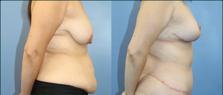 Breast lift (mastopexy) before and after, female patient, case BLI-L03, Dr Rohit Kumar, Sydney