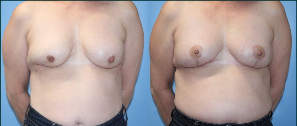 Breast lift (mastopexy) before and after, female patient, case BLI-L04, Dr Rohit Kumar, Sydney