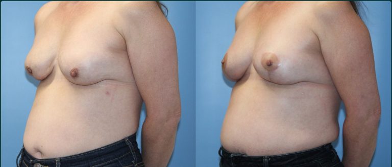 Breast lift (mastopexy) before and after, female patient, case BLI-L04, Dr Rohit Kumar, Sydney