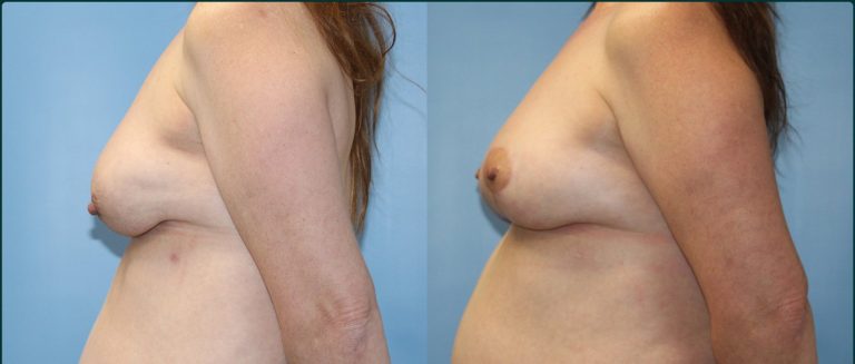 Breast lift (mastopexy) before and after, female patient, case BLI-L04, Dr Rohit Kumar, Sydney