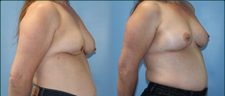 Breast lift (mastopexy) before and after, female patient, case BLI-L04, Dr Rohit Kumar, Sydney