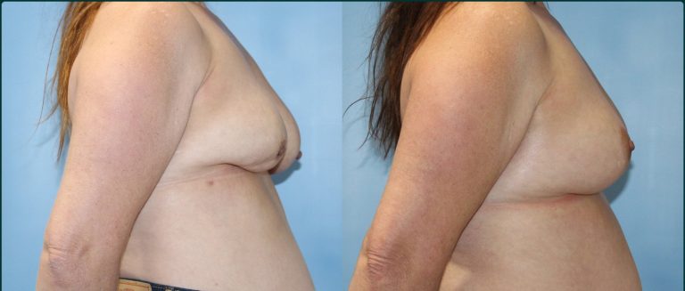 Breast lift (mastopexy) before and after, female patient, case BLI-L04, Dr Rohit Kumar, Sydney
