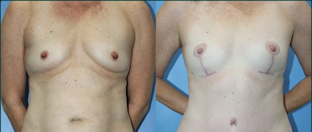 Breast lift (mastopexy) before and after, female patient, case BLI-L05, Dr Rohit Kumar, Sydney