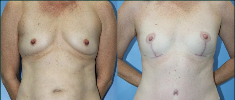 Breast lift (mastopexy) before and after, female patient, case BLI-L05, Dr Rohit Kumar, Sydney