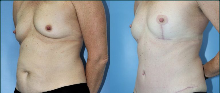 Breast lift (mastopexy) before and after, female patient, case BLI-L05, Dr Rohit Kumar, Sydney