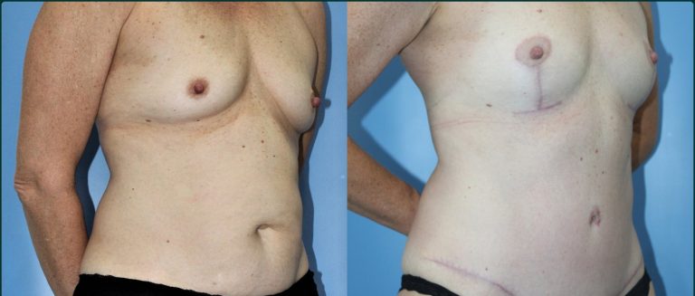 Breast lift (mastopexy) before and after, female patient, case BLI-L05, Dr Rohit Kumar, Sydney