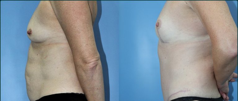 Breast lift (mastopexy) before and after, female patient, case BLI-L05, Dr Rohit Kumar, Sydney