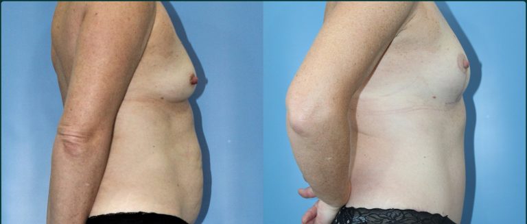 Breast lift (mastopexy) before and after, female patient, case BLI-L05, Dr Rohit Kumar, Sydney