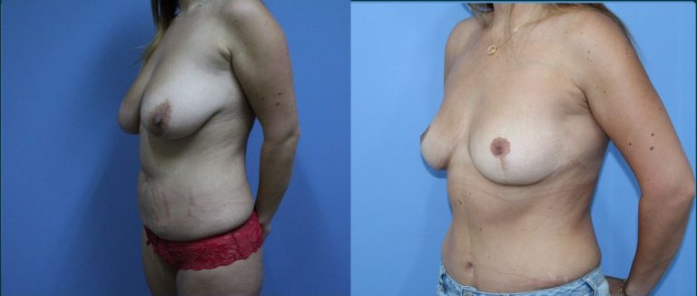 Breast lift (mastopexy) before and after, 45° left view, female patient, case BLI-L06, Dr Rohit Kumar, Sydney