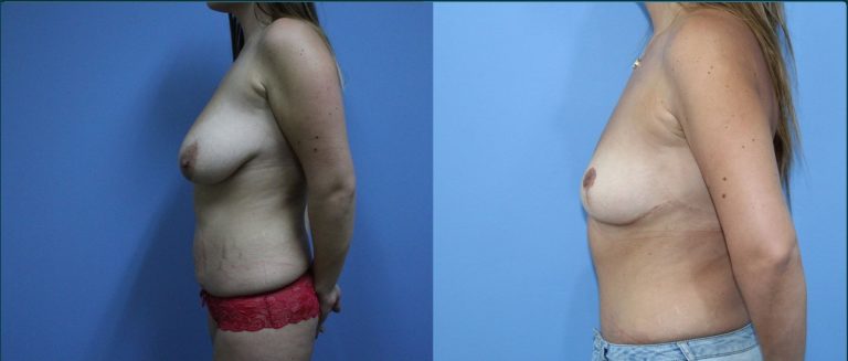 Breast lift (mastopexy) before and after, 90° left view, female patient, case BLI-L06, Dr Rohit Kumar, Sydney