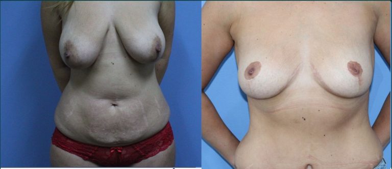 Breast lift (mastopexy) before and after, front view, female patient, case BLI-L06, Dr Rohit Kumar, Sydney