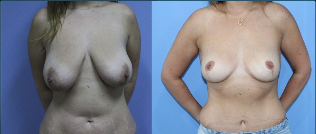 Breast lift (mastopexy) before and after, front view, female patient, case BLI-L06, Dr Rohit Kumar, Sydney