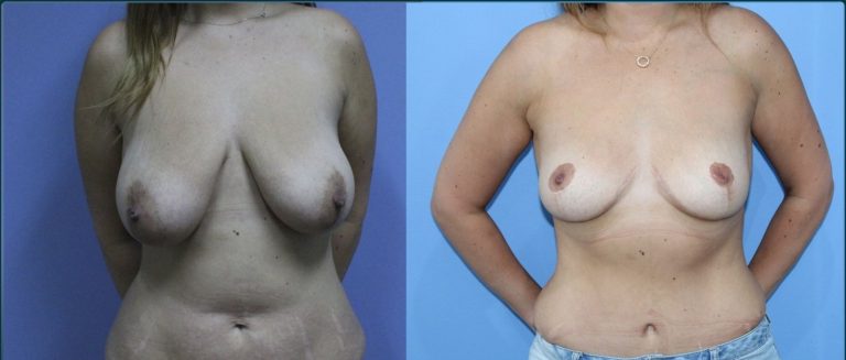 Breast lift (mastopexy) before and after, front view, female patient, case BLI-L06, Dr Rohit Kumar, Sydney