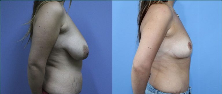 Breast lift (mastopexy) before and after, female patient, case BLI-L06, Dr Rohit Kumar, Sydney