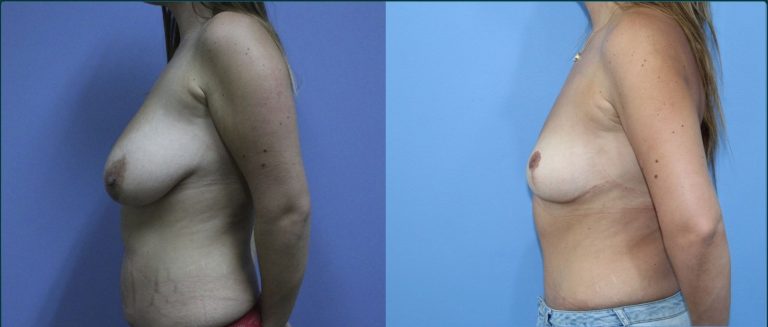 Breast lift (mastopexy) before and after, female patient, case BLI-L06, Dr Rohit Kumar, Sydney