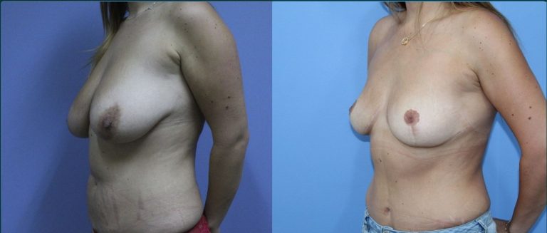 Breast lift (mastopexy) before and after, female patient, case BLI-L06, Dr Rohit Kumar, Sydney