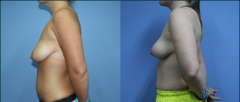 Breast lift (mastopexy) before and after, 90° left view, female patient, case BLI-L07, Dr Rohit Kumar, Sydney