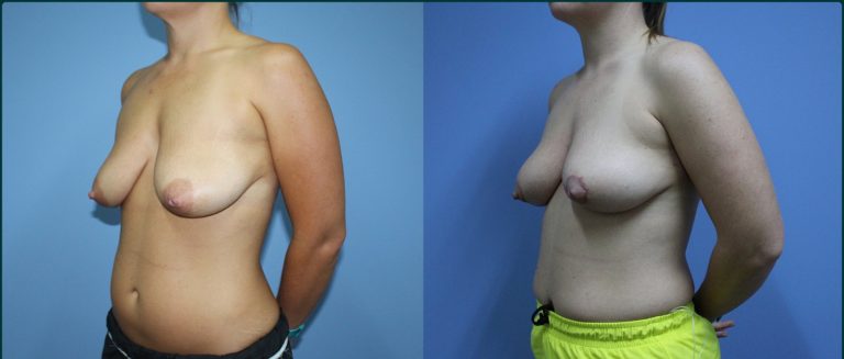 Breast lift (mastopexy) before and after, 90° left view, female patient, case BLI-L07, Dr Rohit Kumar, Sydney
