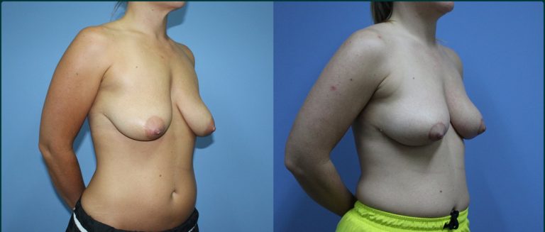 Breast lift (mastopexy) before and after, 90° right view, female patient, case BLI-L07, Dr Rohit Kumar, Sydney