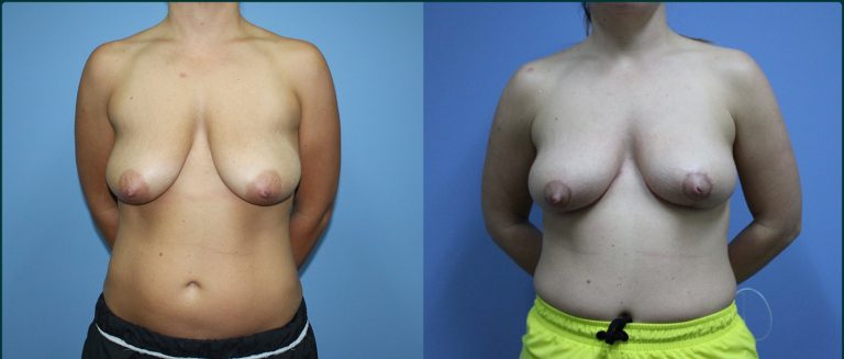 Breast lift (mastopexy) before and after, front view, female patient, case BLI-L07, Dr Rohit Kumar, Sydney