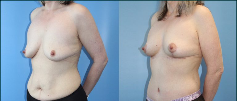 Breast lift (mastopexy) before and after, 45° left view, female patient, case BLI-L08, Dr Rohit Kumar, Sydney