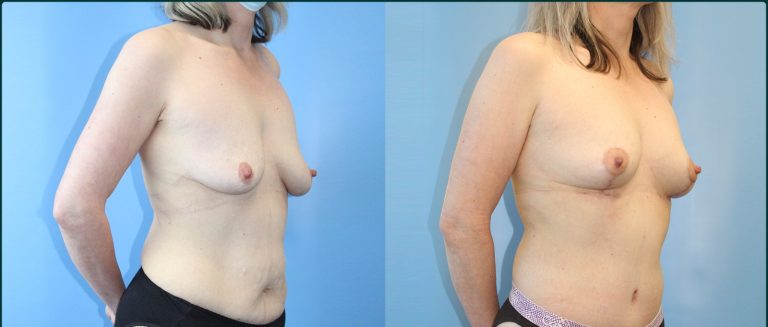 Breast lift (mastopexy) before and after, 45° right view, female patient, case BLI-L08, Dr Rohit Kumar, Sydney