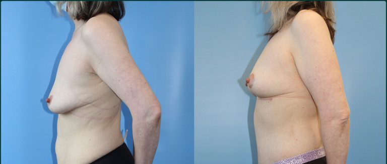Breast lift (mastopexy) before and after, 90° left view, female patient, case BLI-L08, Dr Rohit Kumar, Sydney