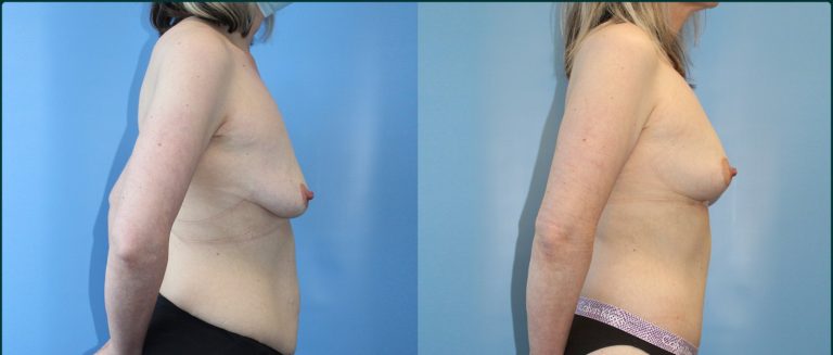 Breast lift (mastopexy) before and after, 90° right view, female patient, case BLI-L08, Dr Rohit Kumar, Sydney