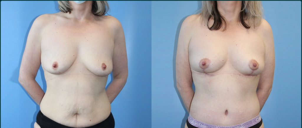 Breast lift (mastopexy) before and after, front view, female patient, case BLI-L08, Dr Rohit Kumar, Sydney