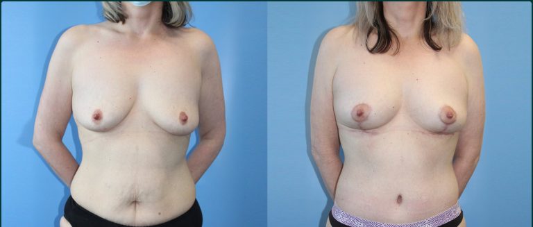 Breast lift (mastopexy) before and after, front view, female patient, case BLI-L08, Dr Rohit Kumar, Sydney
