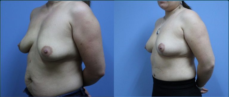 Breast lift (mastopexy) before and after, 45° left view, female patient, case BLI-L09, Dr Rohit Kumar, Sydney