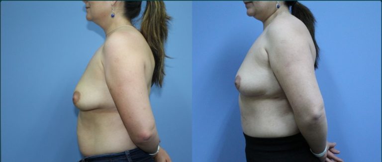 Breast lift (mastopexy) before and after, 90° left view, female patient, case BLI-L09, Dr Rohit Kumar, Sydney