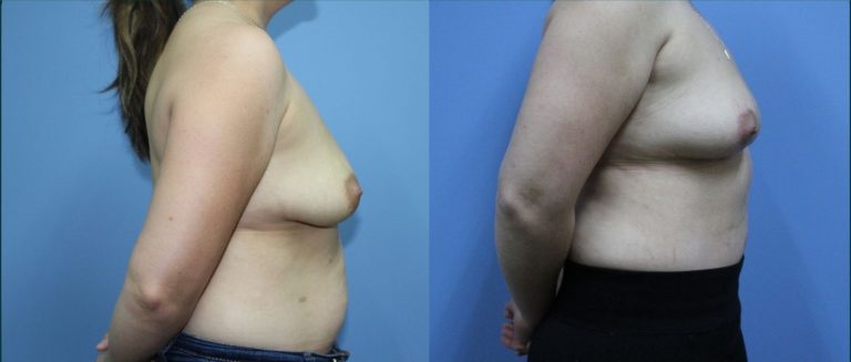 Breast lift (mastopexy) before and after, 90° right view, female patient, case BLI-L09, Dr Rohit Kumar, Sydney