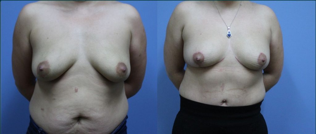 Breast lift (mastopexy) before and after, front view, female patient, case BLI-L09, Dr Rohit Kumar, Sydney