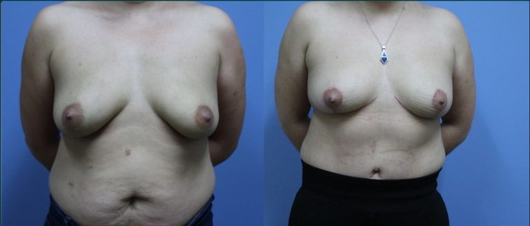 Breast lift (mastopexy) before and after, front view, female patient, case BLI-L09, Dr Rohit Kumar, Sydney
