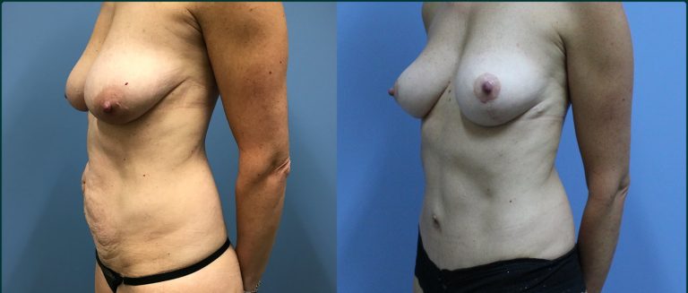 Breast lift (mastopexy) before and after, 45° left view, female patient, case BLI-L10, Dr Rohit Kumar, Sydney