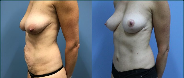 Breast lift (mastopexy) before and after, 45° left view, female patient, case BLI-L10, Dr Rohit Kumar, Sydney