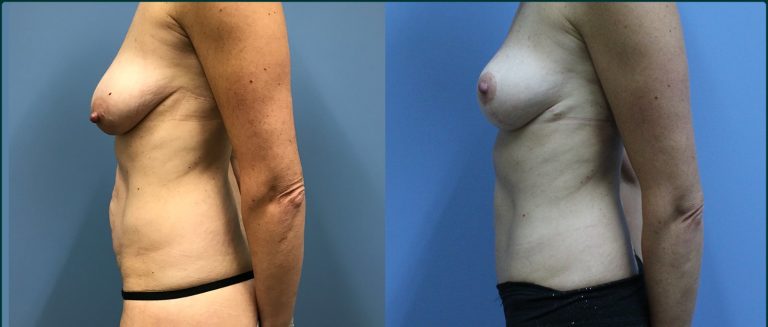 Breast lift (mastopexy) before and after, 90° left view, female patient, case BLI-L10, Dr Rohit Kumar, Sydney