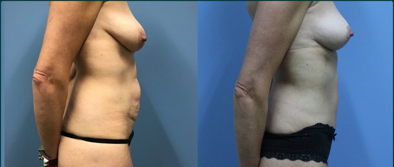 Breast lift (mastopexy) before and after, 90° right view, female patient, case BLI-L10, Dr Rohit Kumar, Sydney