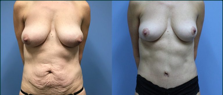 Breast lift (mastopexy) before and after, front view, female patient, case BLI-L10, Dr Rohit Kumar, Sydney